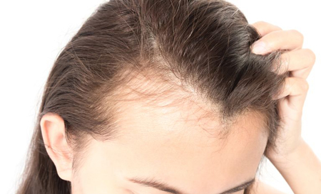 جلوگیری از ریزش موی سر