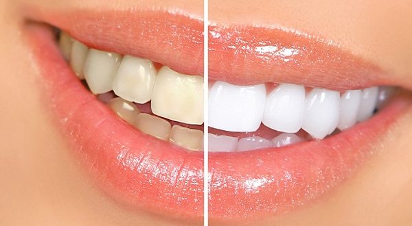 ۶ اشتباهی که دندان‌ها را زرد می‌کنند