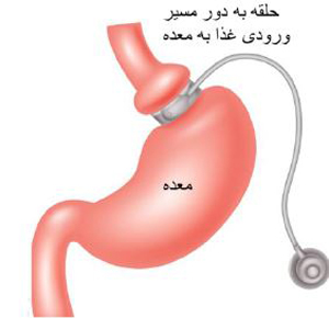 جراحی چاقی بدن, عوارض جراحی چاقی