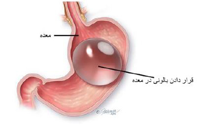 جراحی چاقی بدن, عوارض جراحی چاقی