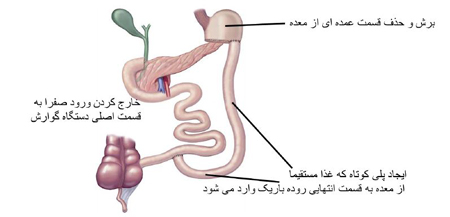 جراحی چاقی بدن, عوارض جراحی چاقی