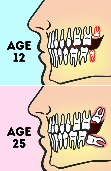 ترمیم دندان عقل, آیا درد دندان عقل طبیعی است
