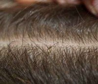 درمان شپش موی سر با اسپند