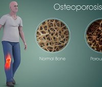 درمان پوکی استخوان با راهکارهای طلایی طب سنتی