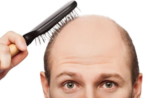دلایل ریزش مو به همراه درمان های موثر و اساسی