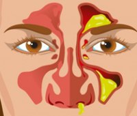 هر رنگ مخاط بینی نشانه چیست؟