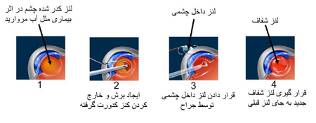 روش نگهداری لنز طبی, موارد مصرف لنز طبی