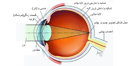 روش نگهداری لنز طبی, موارد مصرف لنز طبی