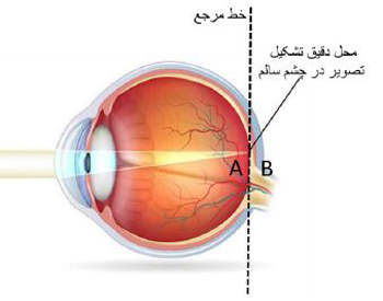 روش نگهداری لنز طبی, موارد مصرف لنز طبی