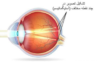 روش نگهداری لنز طبی, موارد مصرف لنز طبی