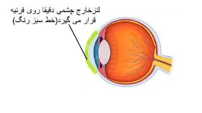 روش نگهداری لنز طبی, موارد مصرف لنز طبی