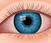 همه چیز درباره خشکی چشم