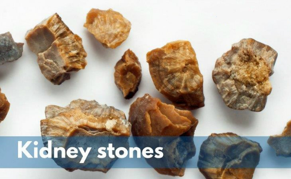 همه چیز درباره سنگ کلیه؛ از علت تا روش های جلوگیری و درمان آن 1 سنگ کلیه