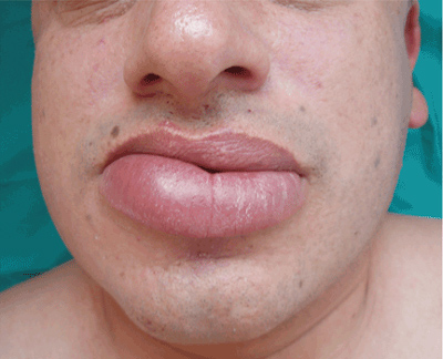 علت ورم لب, علت ورم ناگهانی یک طرف صورت