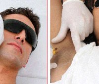 چگونه بهترین نتیجه را از لیزر موهای زائد بگیریم؟