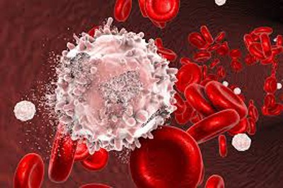 نشانهها و علائم خاموش سرطان خون 6 symptoms leukemia2 3