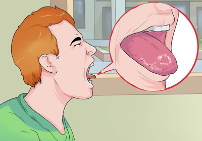 درمان سوختگی زبان و گلو